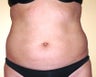 Ultrasonic assisted (VASER) Liposuction