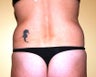 Ultrasonic assisted (Vaser) Liposuction of Flanks