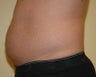 Male Liposuction - Abdomen
