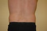 Male liposuction - flank