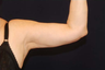 Liposuction