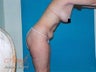 Vaser Lipo - Abdomen