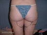 Vaser Lipo - Outer Thighs