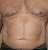 VASER liposuction of abdominal wall