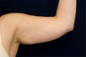 Liposuction