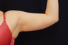 Liposuction