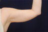 Liposuction