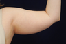 Liposuction