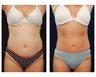 Liposuction