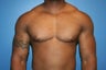VASER Liposuction for gynecomastia