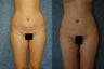 VASER Liposuction