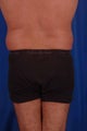 45 year-old male- liposuction of flanks