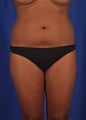 26 year-old woman- liposuction of her abdomen