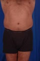 45 year-old male treated with liposuction of abdomen and flanks