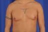 31 year-old male with gynecomastia