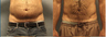 Vaser Liposelection