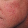 Rosacea/Facial veins