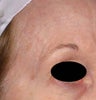 Blue veins around eyes