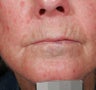 Vascular malformations