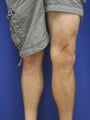 vnus ablation
