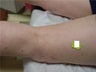 Sclerotherapy