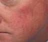 Rosacea/Facial veins