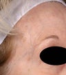 Blue veins around eyes