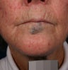 Vascular malformations