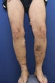 vnus ablation