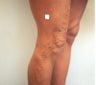 vnus ablation