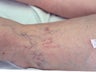 Sclerotherapy