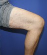 vnus ablation