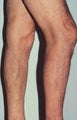 Phlebectomy Leg Vein Removal
