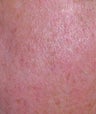 Laser vein treatment