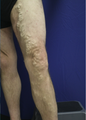vnus ablation