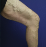 vnus ablation
