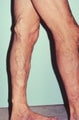 Phlebectomy Leg Vein Removal
