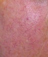 Laser vein treatment