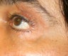 Laser Vein Treatment