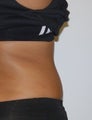 Cool Sculpting