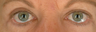 Botox for Wrinkle Treatment