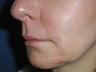 Radiesse for Nasolabial Folds
