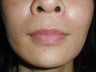 Radiesse in smile lines (Nasolabial Folds)