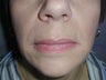 Restylane for smile lines (nasolabial folds)