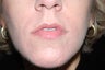 Nasal labial folds treatment with Evolence