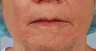 Perlane to the Lower Face