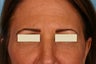 Frown lines treatment