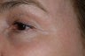 Crow's feet treatment