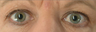 Botox for Wrinkle Treatment