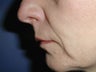 Radiesse for Nasolabial Folds